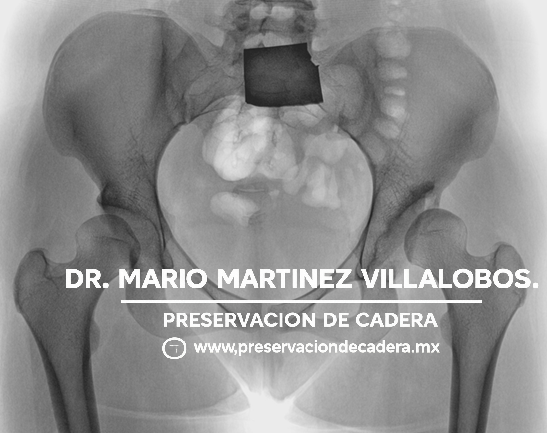 Radiografía diagnóstica de displasia acetabular