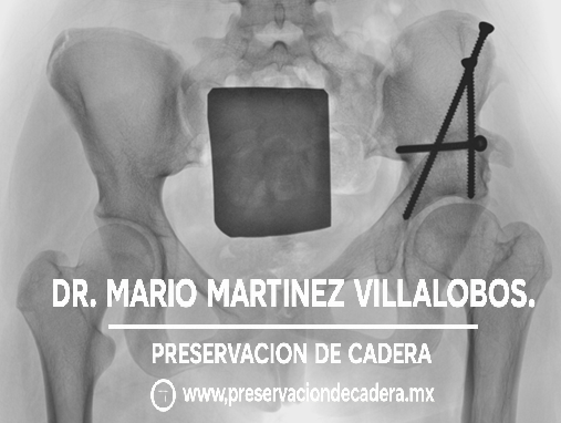 Radiografía postoperatoria PAO