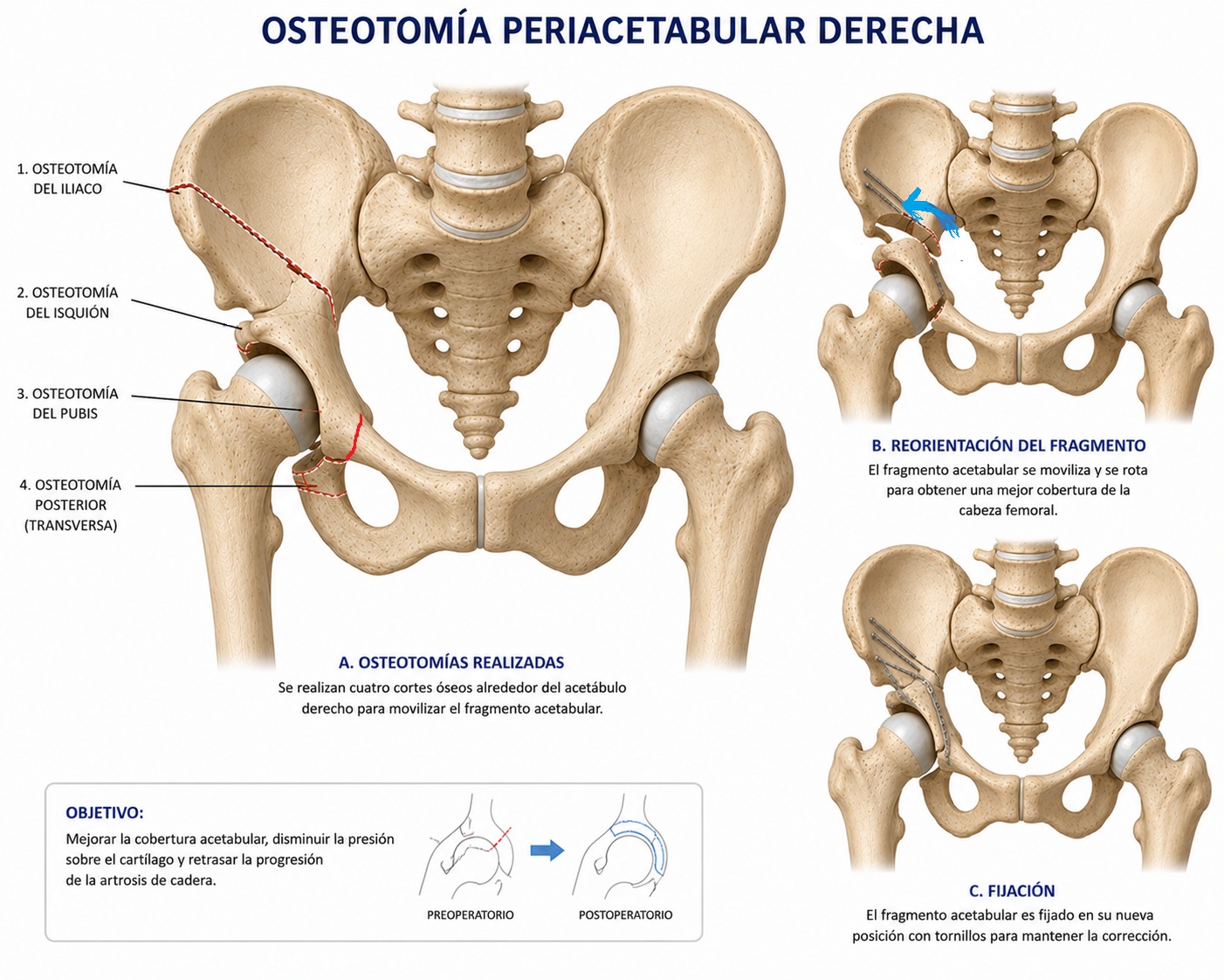 Dibujo de la técnica de osteotomía periacetabular