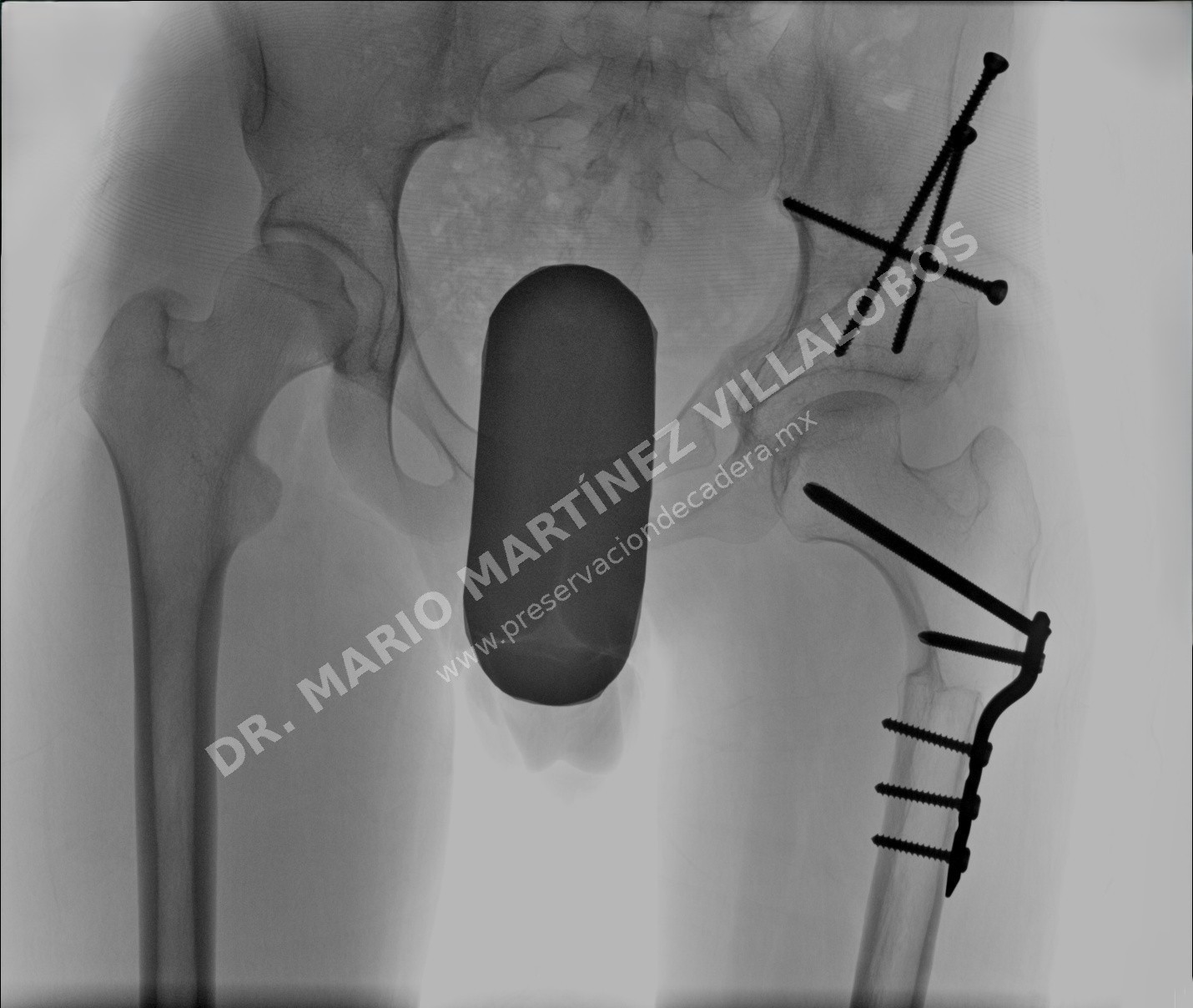 Radiografía postoperatoria de osteotomía periacetabular